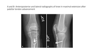 A and B- Anteroposterior and lateral radiographs of knee in maximal extension after
patellar tendon advancement
 