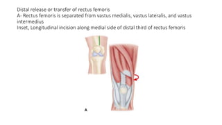 Distal release or transfer of rectus femoris
A- Rectus femoris is separated from vastus medialis, vastus lateralis, and vastus
intermedius
Inset, Longitudinal incision along medial side of distal third of rectus femoris
 