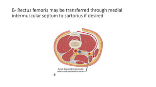 B- Rectus femoris may be transferred through medial
intermuscular septum to sartorius if desired
 