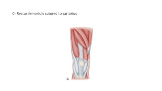 C- Rectus femoris is sutured to sartorius
 