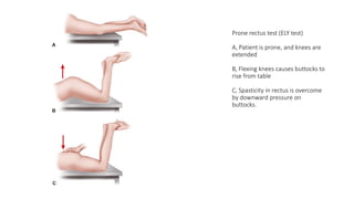 Prone rectus test (ELY test)
A, Patient is prone, and knees are
extended
B, Flexing knees causes buttocks to
rise from table
C, Spasticity in rectus is overcome
by downward pressure on
buttocks.
 