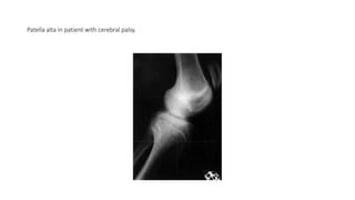 Patella alta in patient with cerebral palsy.
 