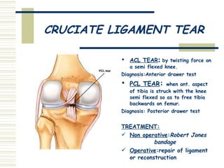CRUCIATE LIGAMENT TEAR ACL TEAR :  by twisting force on a semi flexed knee. Diagnosis:Anterior drawer test  PCL TEAR :  when ant. aspect of tibia is struck with the knee semi flexed so as to free tibia backwards on femur . Diagnosis: Posterior drawer test  TREATMENT: Non operative : Robert Jones  bandage Operative :repair of ligament or reconstruction 