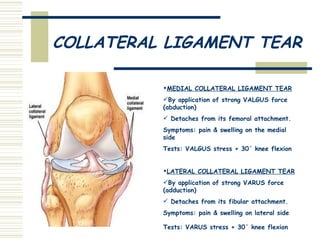 COLLATERAL LIGAMENT TEAR MEDIAL COLLATERAL LIGAMENT TEAR By application of strong VALGUS force (abduction) Detaches from its femoral attachment. Symptoms: pain & swelling on the medial side Tests: VALGUS stress + 30΄ knee flexion  LATERAL COLLATERAL LIGAMENT TEAR By application of strong VARUS force (adduction) Detaches from its fibular attachment. Symptoms: pain & swelling on lateral side Tests: VARUS stress + 30΄ knee flexion   