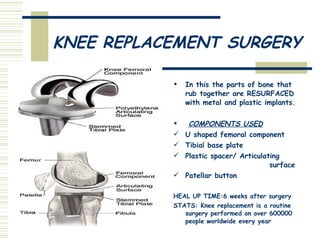KNEE REPLACEMENT SURGERY In this the parts of bone that rub together are RESURFACED with metal and plastic implants. COMPONENTS USED U shaped femoral component Tibial base plate Plastic spacer/ Articulating  surface Patellar button HEAL UP TIME:6 weeks after surgery STATS: Knee replacement is a routine surgery performed on over 600000 people worldwide every year 