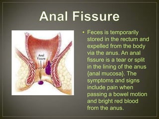 • Feces is temporarily
  stored in the rectum and
  expelled from the body
  via the anus. An anal
  fissure is a tear or split
  in the lining of the anus
  {anal mucosa}. The
  symptoms and signs
  include pain when
  passing a bowel motion
  and bright red blood
  from the anus.
 