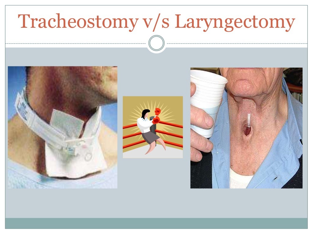 The laryngectomy patient