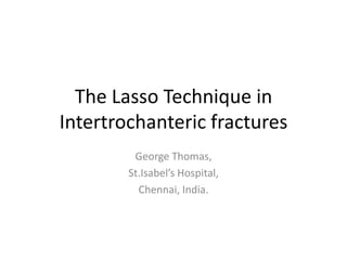 The Lasso Technique in
Intertrochanteric fractures
George Thomas,
St.Isabel’s Hospital,
Chennai, India.

 