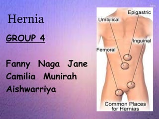 Hernia
GROUP 4
Fanny Naga Jane
Camilia Munirah
Aishwarriya
1
 