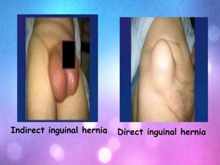 Hernia  Slide 11