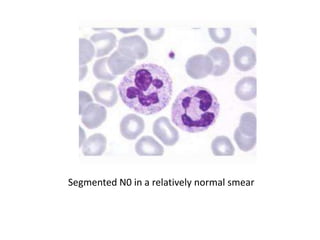 Segmented N0 in a relatively normal smear
 