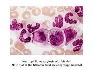 Neutrophilic leukocytosis with left shift
Note that all the N0 in the field are early stage band N0
 