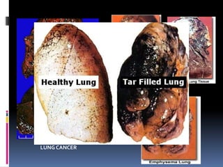 The lungs presentation