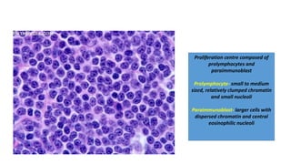 Proliferation centre composed of
prolymphocytes and
paraimmunoblast
Prolymphocyte- small to medium
sized, relatively clumped chromatin
and small nucleoli
Paraimmunoblast- larger cells with
dispersed chromatin and central
eosinophilic nucleoli
 