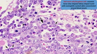 Hall mark cells/doughnut cells- eccentric
horse shoe shaped/ kidney shaped nuclei
with eosinophilic nucleoli often concentrated
around blood vessels
 