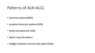 Patterns of ALK+ALCL
• Common pattern(60%)
• Lympho-histiocytic pattern(10%)
• Small cell pattern(5-10%)
• Signet ring cell pattern
• Hodgkin Nodular sclerosis like pattern(3%)
 