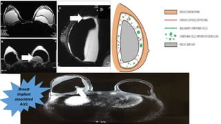 Breast
implant
associated
ALCL
 