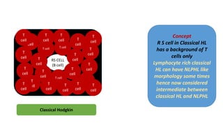 RS CELL
(B cell)
T cell T cell
T
cell
T
cell
T cell
T
cell
T
cell T
cell
T
cell
T
cell
B
cell
T
cell
T
cell
T
cell
T
cell
T
cell
T
cell
T
cell
T
cell
T
cell
T
cell
T
cell
T
cell
Classical Hodgkin
Concept
R S cell in Classical HL
has a background of T
cells only
Lymphocyte rich classical
HL can have NLPHL like
morphology some times
hence now considered
intermediate between
classical HL and NLPHL
 