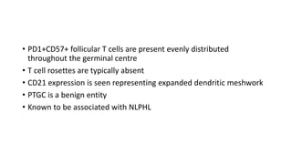 • PD1+CD57+ follicular T cells are present evenly distributed
throughout the germinal centre
• T cell rosettes are typically absent
• CD21 expression is seen representing expanded dendritic meshwork
• PTGC is a benign entity
• Known to be associated with NLPHL
 