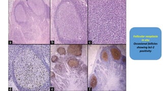Follicular neoplasia
in situ
Occasional follicles
showing bcl-2
positivity
 