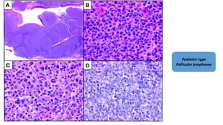 Pediatric type
Follicular lymphoma
 