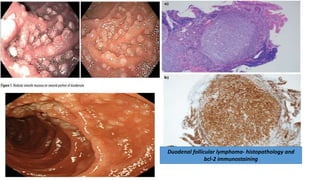 Duodenal follicular lymphoma- histopathology and
bcl-2 immunostaining
 