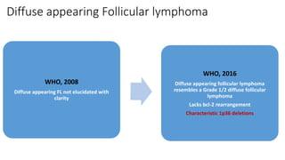 Diffuse appearing Follicular lymphoma
WHO, 2008
Diffuse appearing FL not elucidated with
clarity
WHO, 2016
Diffuse appearing follicular lymphoma
resembles a Grade 1/2 diffuse follicular
lymphoma
Lacks bcl-2 rearrangement
Characteristic 1p36 deletions
 