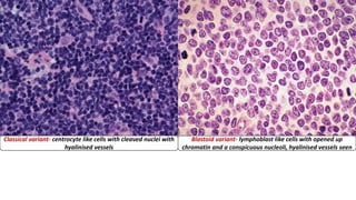 Classical variant- centrocyte like cells with cleaved nuclei with
hyalinised vessels
Blastoid variant- lymphoblast like cells with opened up
chromatin and a conspicuous nucleoli, hyalinised vessels seen
 