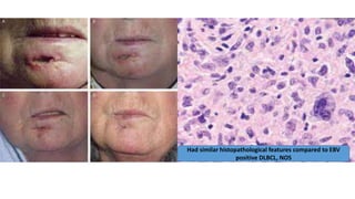 Had similar histopathological features compared to EBV
positive DLBCL, NOS
 