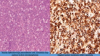 Heavily infiltrated large plasmablastic cells, sometimes may
coalesce to form microlymphomas Stippled nuclear membrane LANA-1 positivity
 