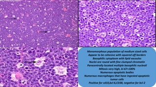 Monomorphous population of medium sized cells
Appear to be cohesive with squared off borders
Basophilic cytoplasm with lipid vacoules
Nuclei are round with fine clumped chromatin
Paracentrally located multiple basophilic nucleoli
Mitosis very high, ki-67=100%
Numerous apoptotic bodies
Numerous macrophages that have ingested apoptotic
tumor cells
Positive for cd10,bcl-6,CD38, negative for bcl-2
 
