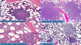 Nodular pattern- favourable prognosis
Mixed pattern
Diffuse pattern - worst prognosis
Interstitial pattern- favourable prognosis
 