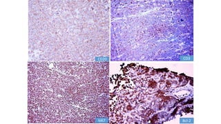 CD20 CD3
ki67 Bcl-2
 