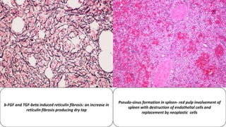 b-FGF and TGF-beta induced reticulin fibrosis: an increase in
reticulin fibrosis producing dry tap
Pseudo-sinus formation in spleen- red pulp involvement of
spleen with destruction of endothelial cells and
replacement by neoplastic cells
 