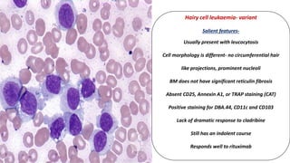 Hairy cell leukaemia- variant
Salient features-
Usually present with leucocytosis
Cell morphology is different- no circumferential hair
like projections, prominent nucleoli
BM does not have significant reticulin fibrosis
Absent CD25, Annexin A1, or TRAP staining (CAT)
Positive staining for DBA.44, CD11c and CD103
Lack of dramatic response to cladribine
Still has an indolent course
Responds well to rituximab
 