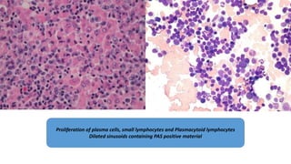 Proliferation of plasma cells, small lymphocytes and Plasmacytoid lymphocytes
Dilated sinusoids containing PAS positive material
 