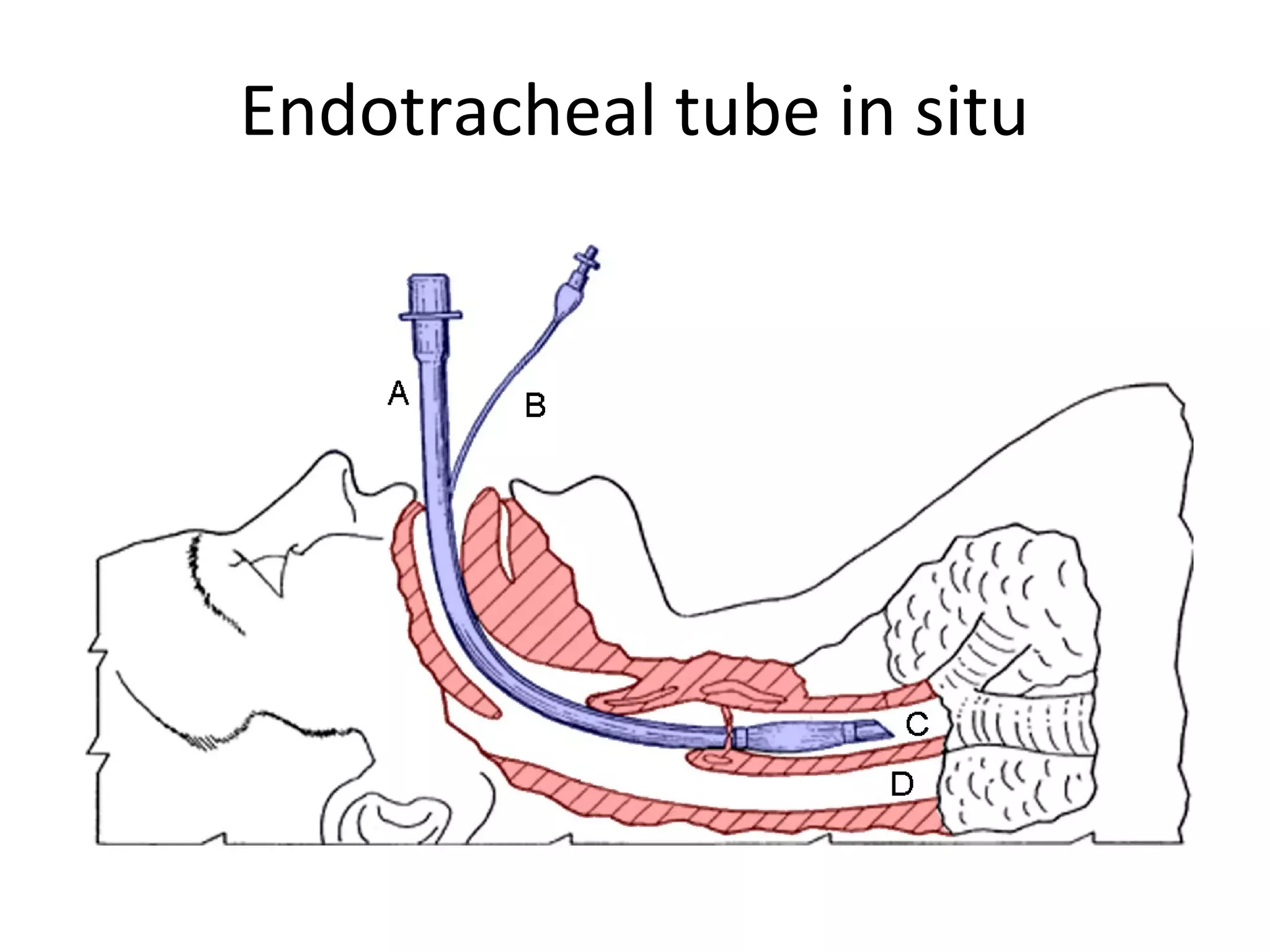 Endotracheal tube in situ
 