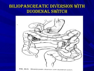 biliopancreatic diversion with duodenal switch 