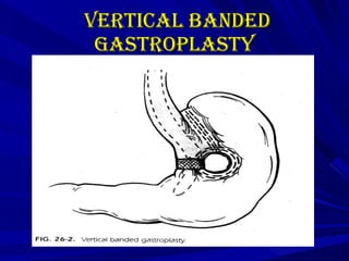 Vertical Banded gastroplasty   