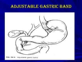 Adjustable gastric band 