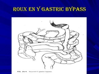 Roux en y gastric bypass 