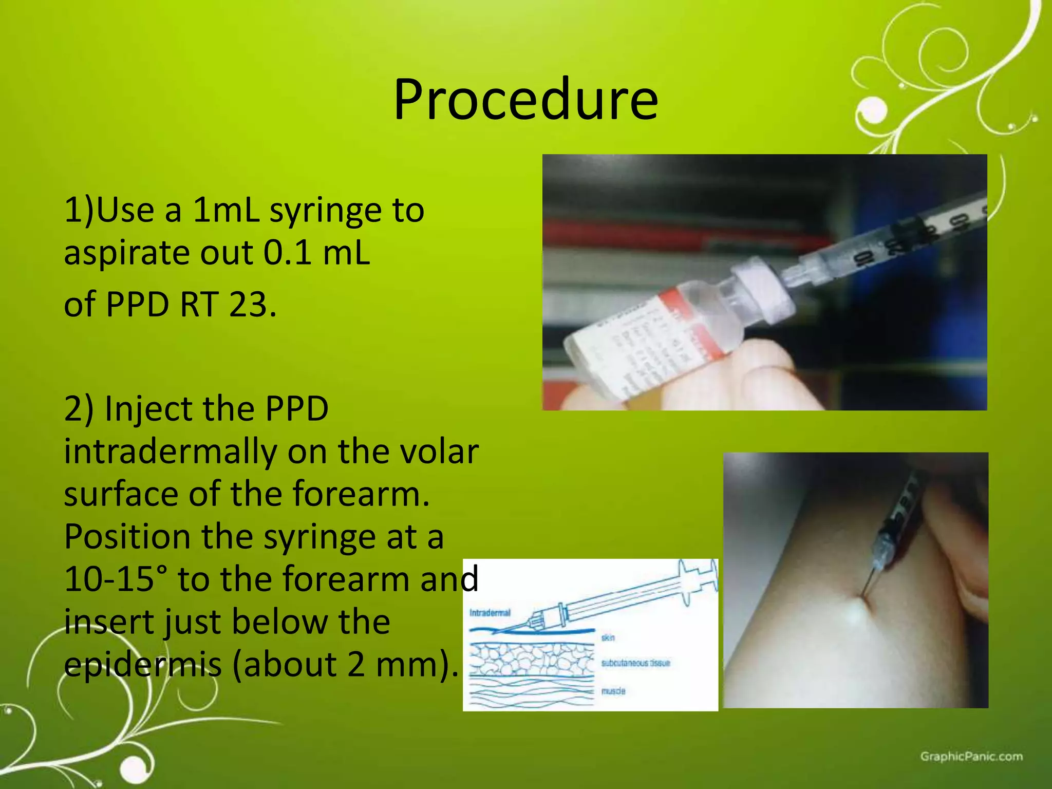 Procedure 
1)Use a 1mL syringe to 
aspirate out 0.1 mL 
of PPD RT 23. 
2) Inject the PPD 
intradermally on the volar 
surface of the forearm. 
Position the syringe at a 
10-15° to the forearm and 
insert just below the 
epidermis (about 2 mm). 
 