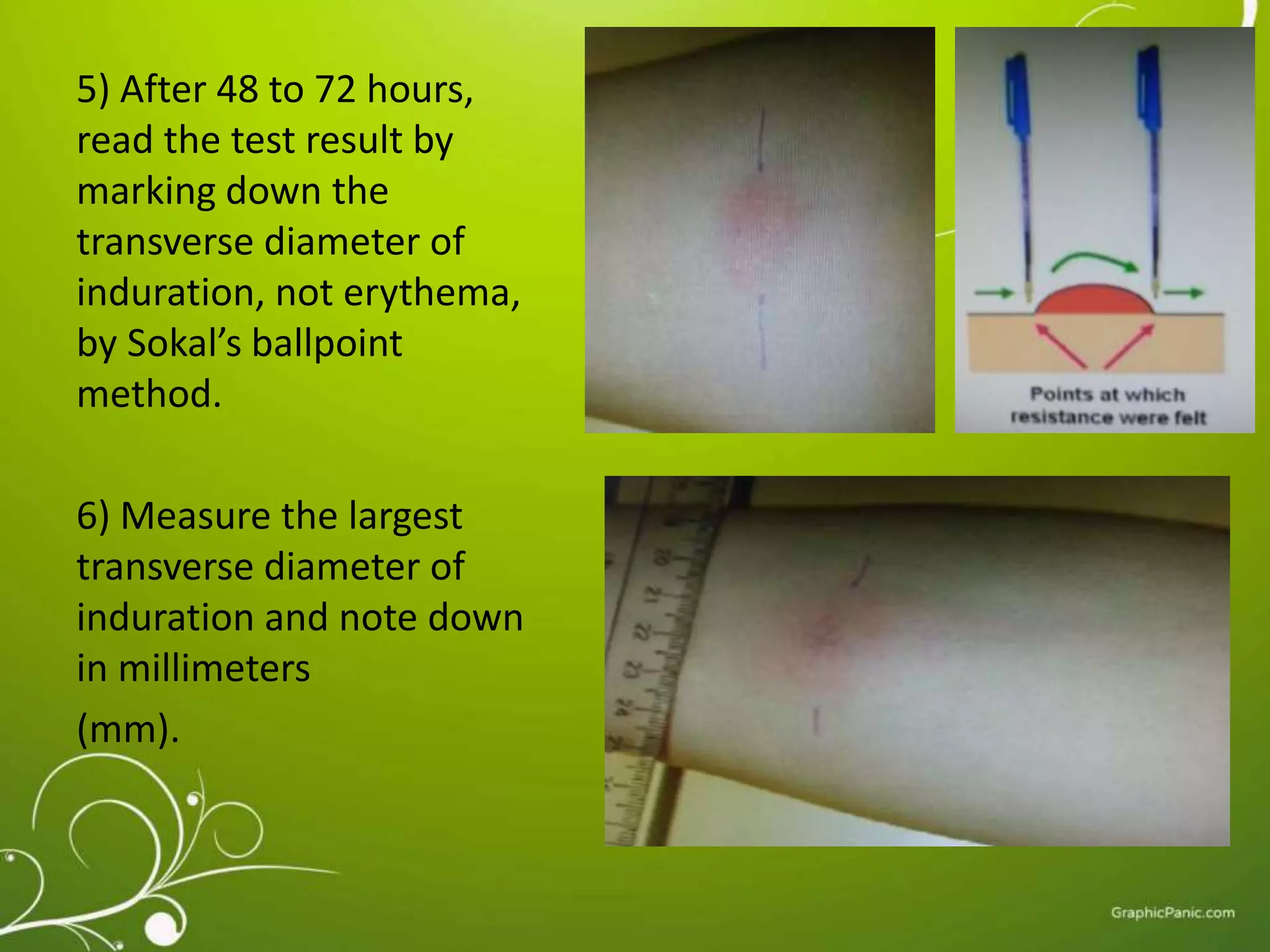 5) After 48 to 72 hours, 
read the test result by 
marking down the 
transverse diameter of 
induration, not erythema, 
by Sokal’s ballpoint 
method. 
6) Measure the largest 
transverse diameter of 
induration and note down 
in millimeters 
(mm). 
 