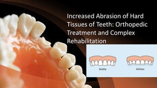 Increased Abrasion of Hard
Tissues of Teeth: Orthopedic
Treatment and Complex
Rehabilitation
 