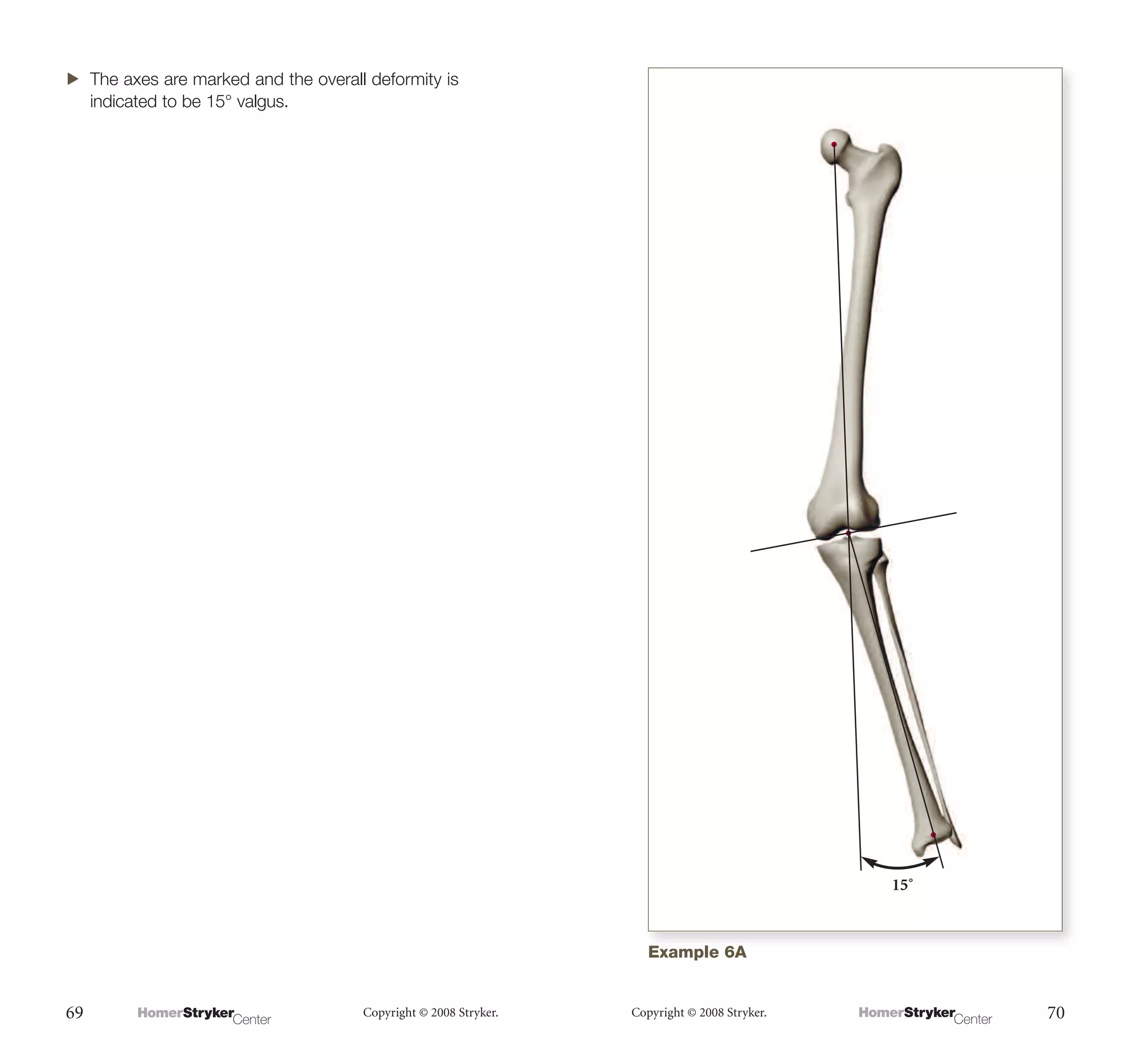 Deformity Example The Measurement and Analysis of Axial Deformity at The Knee.pdf