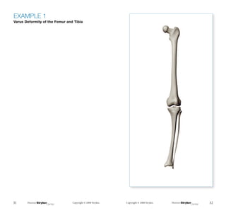 Deformity Example The Measurement and Analysis of Axial Deformity at The Knee.pdf