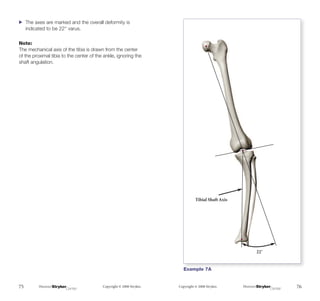The Measurement and Analysis of Axial Deformity at The Knee.pdf