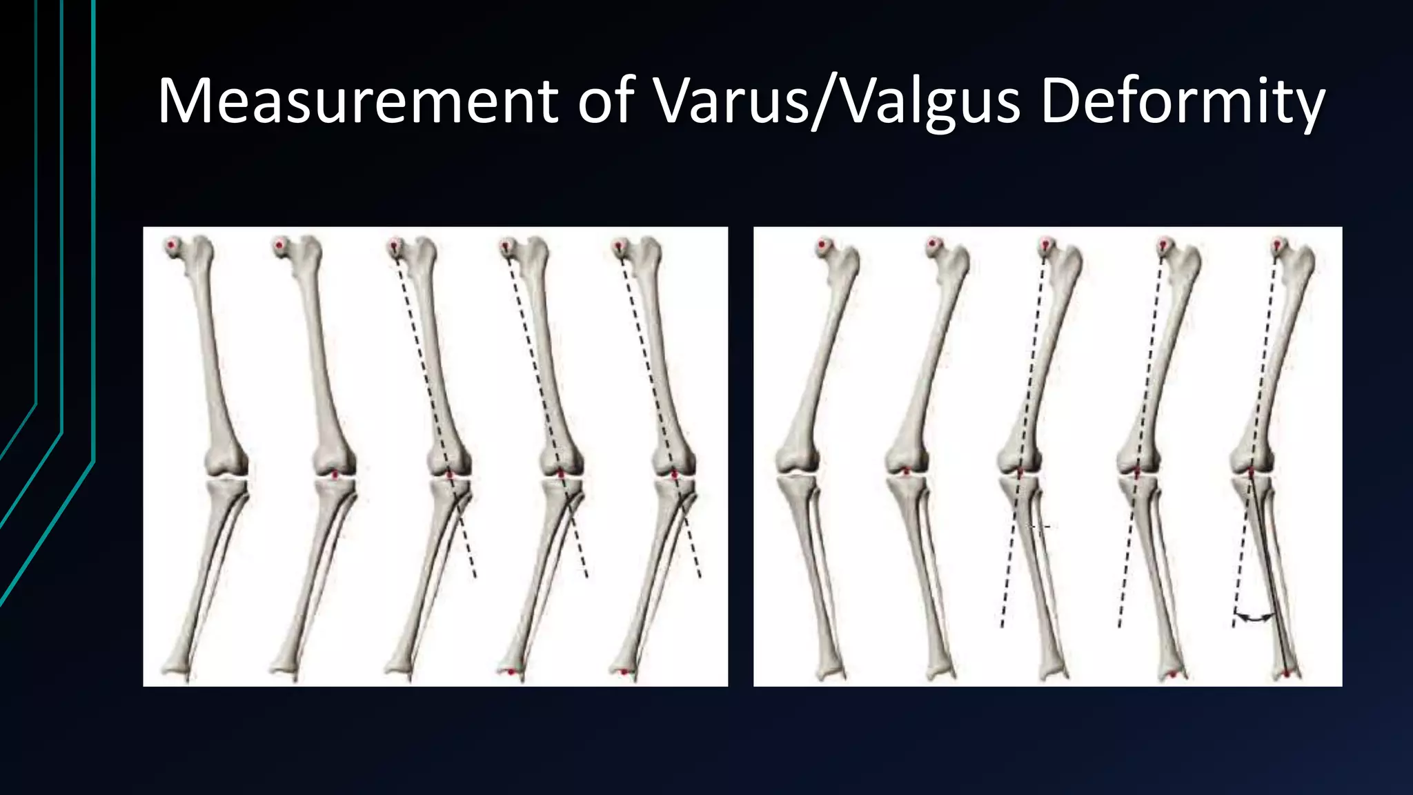 The Measurement and Analysis of Axial Deformity at The Knee.pptx