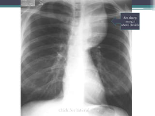 See sharp
margin
above clavicle
Click for lateral view
 