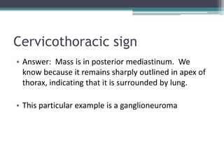 Cervicothoracic sign
• Answer: Mass is in posterior mediastinum. We
know because it remains sharply outlined in apex of
thorax, indicating that it is surrounded by lung.
• This particular example is a ganglioneuroma
 